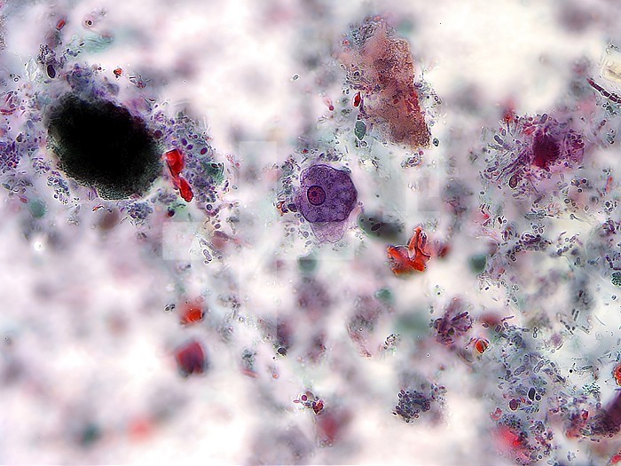 Using trichrome staining, this photomicrograph depicts a trophozoite of the unicellular parasite, Entamoeba histolytica. Colored purple, the trophozoite, seen here in the center of the micrograph, is one of the phases of the life cycle that a protozoan organism goes through, as it matures, and is the active feeding phase of its growth . Other particles surrounding the trophozoite represent debris from the blade specimen. CDC/DPDx - Melanie Moser