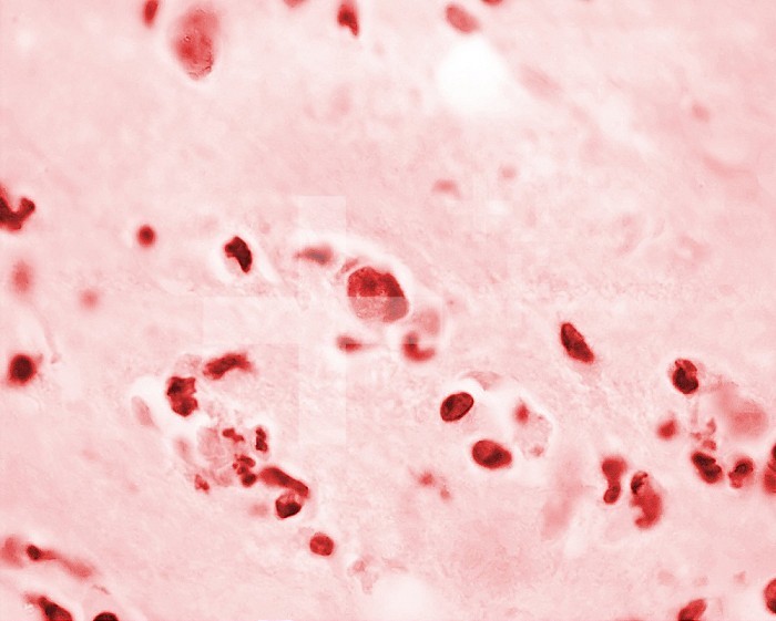 Under 1200X magnification, this 1973 photomicrograph depicted a sample of mouse brain tissue stained using the hematoxylin-eosin (HE) staining technique and revealed the presence of Acanthamoeba polyphaga protozoa. CDC/Dr. George R. Healy 1973