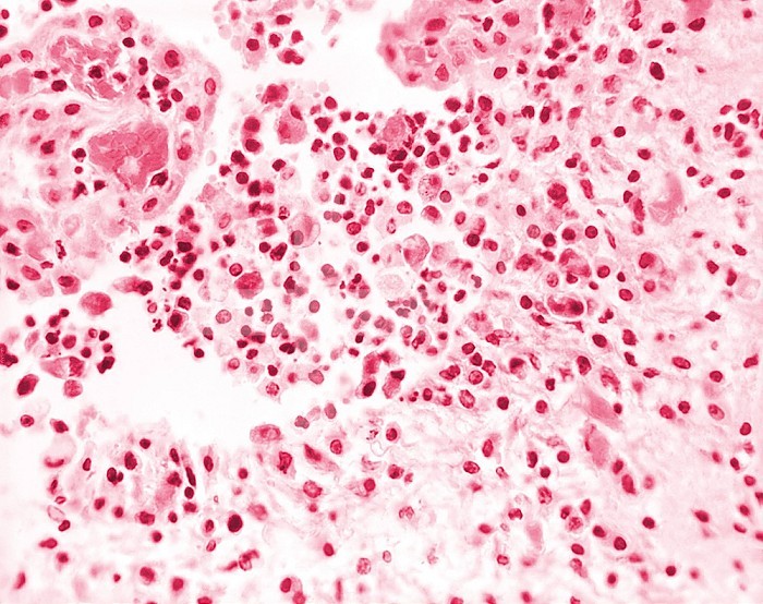 Under 500X magnification, this photomicrograph from 1973 depicted a sample of mouse brain tissue stained using the hematoxylin-eosin (HE) staining technique and revealed the presence of Acanthamoeba polyphaga protozoa. CDC/Dr George Healy 1973