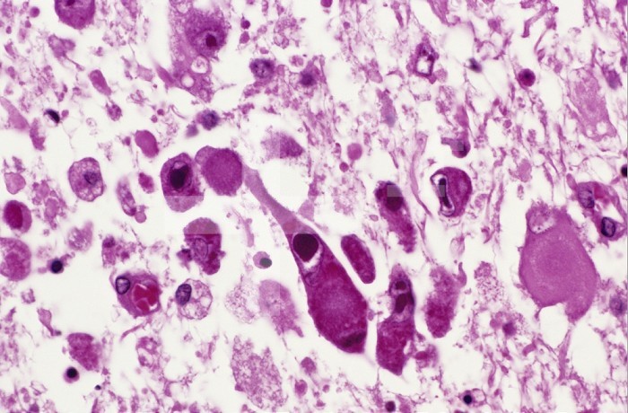 Cytomegalovirus in the brain of a 37 year old man with AIDS showing the typical inclusion bearing cells. LM X160