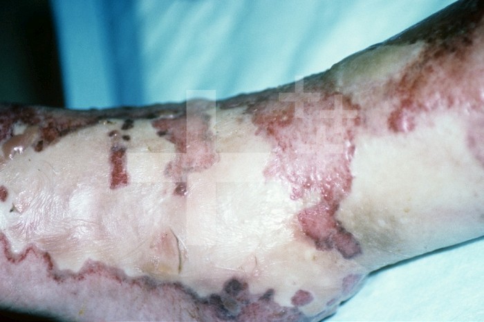 Streptococcal Gangrene or Necrotizing Fasciitis of the foot and ankle, caused by so-called flesh-eating Group A Streptococcus bacteria.