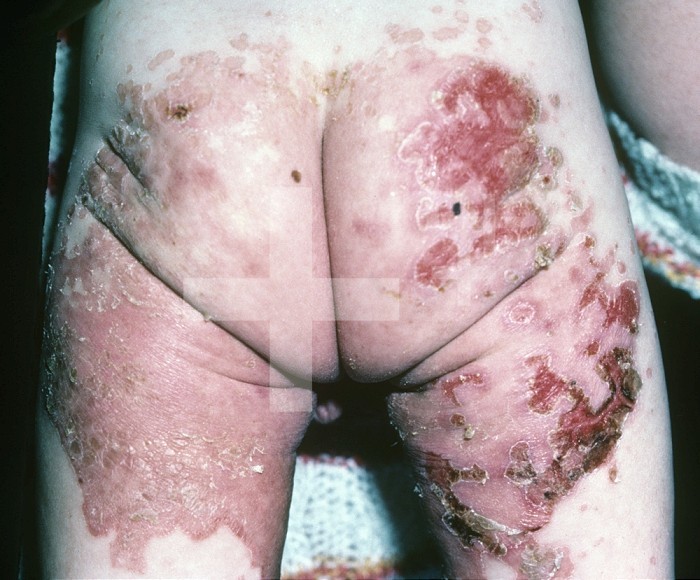 Skin lesions of Acrodermatitis Enteropathica, a rare inherited childhood disorder that results in the inability to absorb zinc from the diet and which may be fatal if untreated.