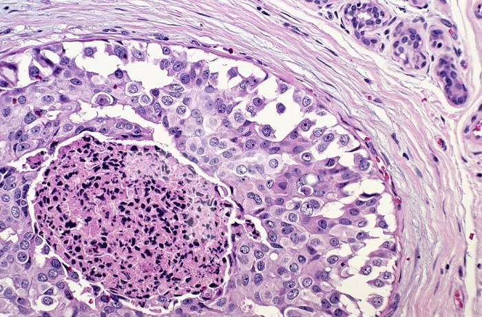 Cross-section of Comedo Intraductal Carcinoma of the human breast in an elderly woman. This high grade carcinoma is still confined within the basement membrane of the the duct so with no contact to lymphatics it is still highly unlikely to be lethal. H&E stain, LM X64.