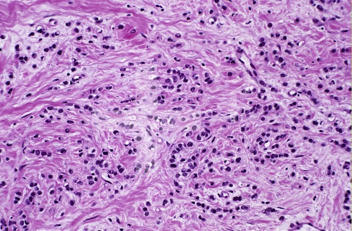 Cross-section of Infiltrating Lobular Carcinoma of the human breast in an elderly woman. Note individual tumor cells streaming through breast stroma, outside of acinar basment membranes, so this tumor is free to spread through lymphatics. H&E stain, LM X64.