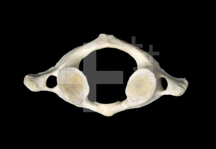 The first human cervical vertebra (atlas or C1) that articulates directly with the base of the skull. Injury to any of the neck vertebrae can be serious and may result in paraplegia or quadriplegia. The spine supports the head, holds the body upright, and protectively encircles the spinal cord which passes through its central cavity. The spine consists of 33 vertebrae, articulated by intervertebral discs which allow flexibility and movement.
