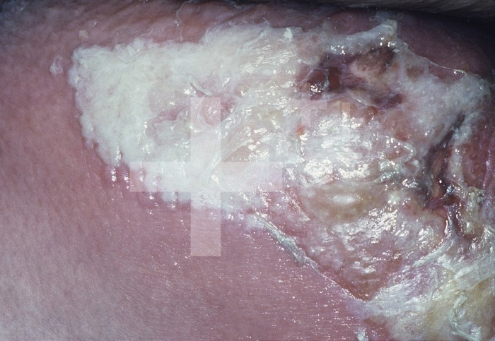 Streptococcal gangrene or necrotizing fasciitis on human skin caused by Group A Streptococcus, the so-called flesh-eating bacterium.