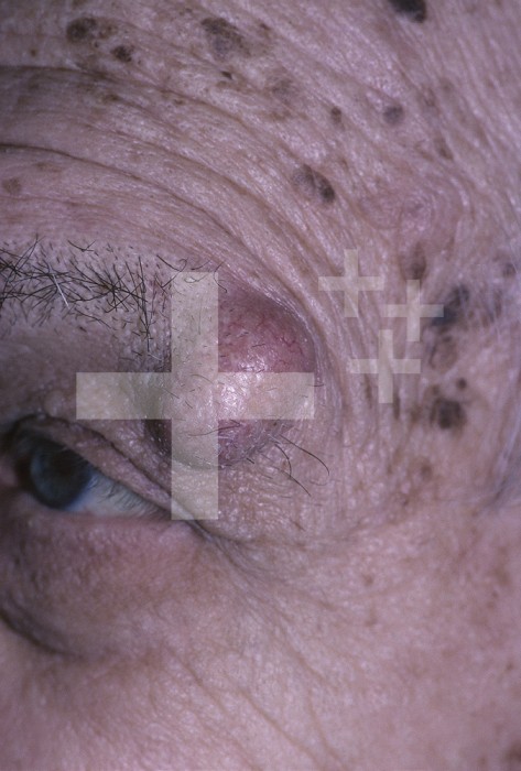 Epidermal inclusion cyst above the eye.