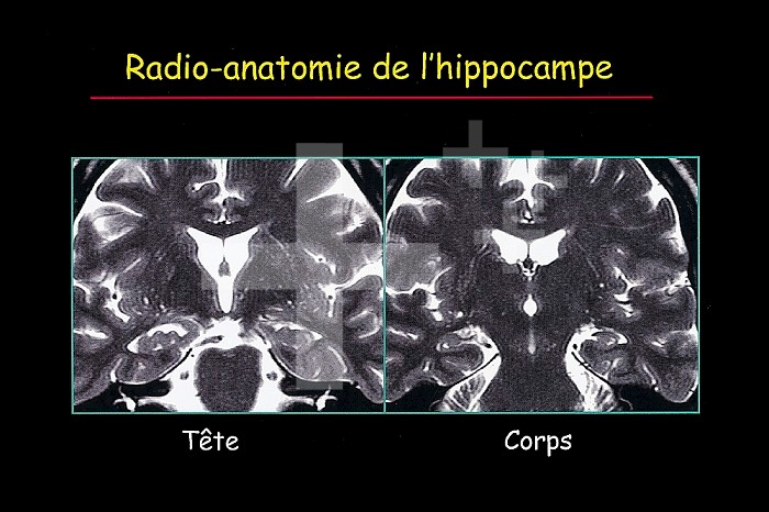 HIPPOCCAMPUS, MRI