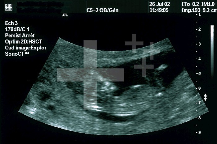 ULTRASOUND BIOMETRY OF THE FETUS