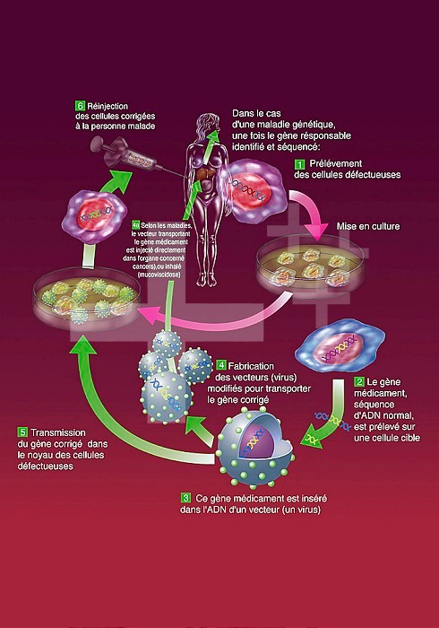 Principle of gene therapies ex vivo and in vivo. Gene therapy ex vivo allies the technics of gene therapy and stem cell therapy. It is a sampling of the patient´s cells, that are then \corrected\ by gene transfer (use of a viral vector), then reimplanted (autotransplantation). Gene therapy in vivo consists in injecting directly the vector bearing the therapeutic genetics into the patient´s body, without going through a transplantation of cells.