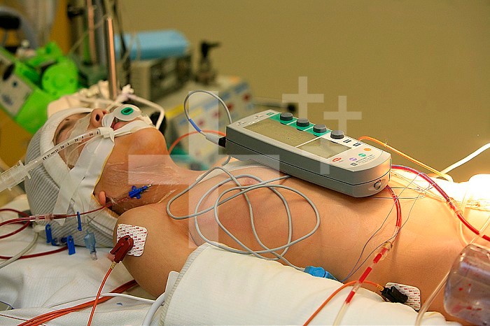 MONITORING A PACEMAKER