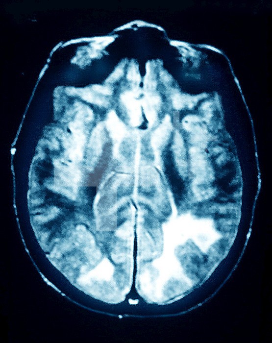 MELAS syndrome, Mitochondrial Encephalomyopathy, Lactic Acidosis, and Stroke-like episodes. Axial CT scan of the brain.
