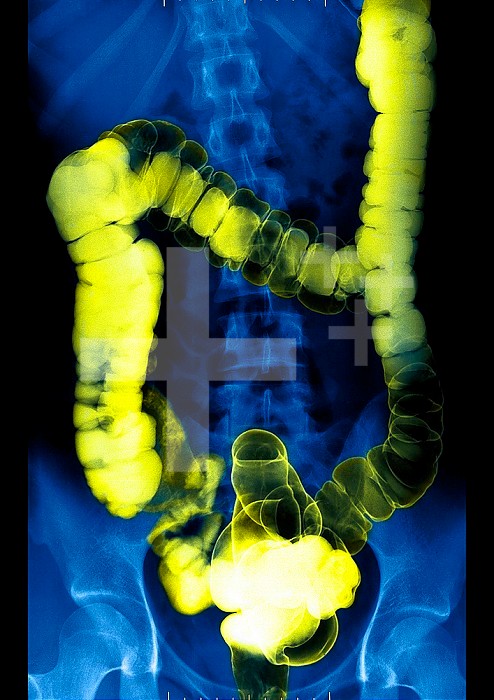 Barium enema of a 30-year old patient´s intestines. X-ray normal.
