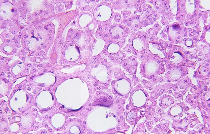 Section of the human kidney with a renal oncocytoma tumor. LM X80