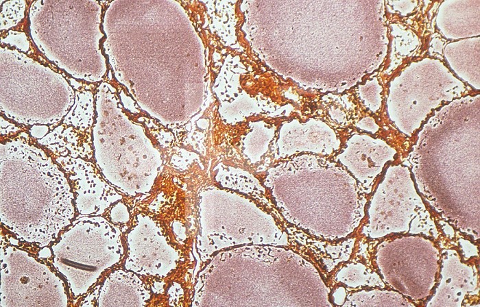 Section of the human thyroid gland. Silver stain, LM.