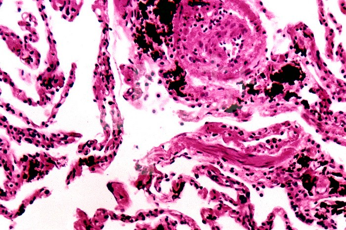 Smoker's lung tissue with tar deposits. LM