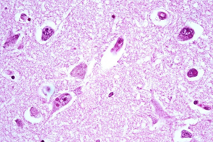 Rabies in the hippocampus region of the brain, with pyramidal cells, Negri bodies, and inclusions, H&E stain. LM X125.