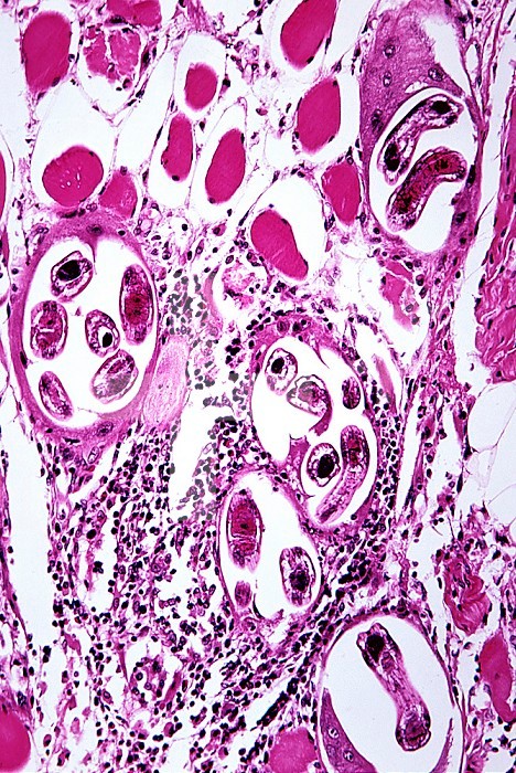 Trichinosis, with Trichinella worms in skeletal muscle, H&E stain. LM X50.