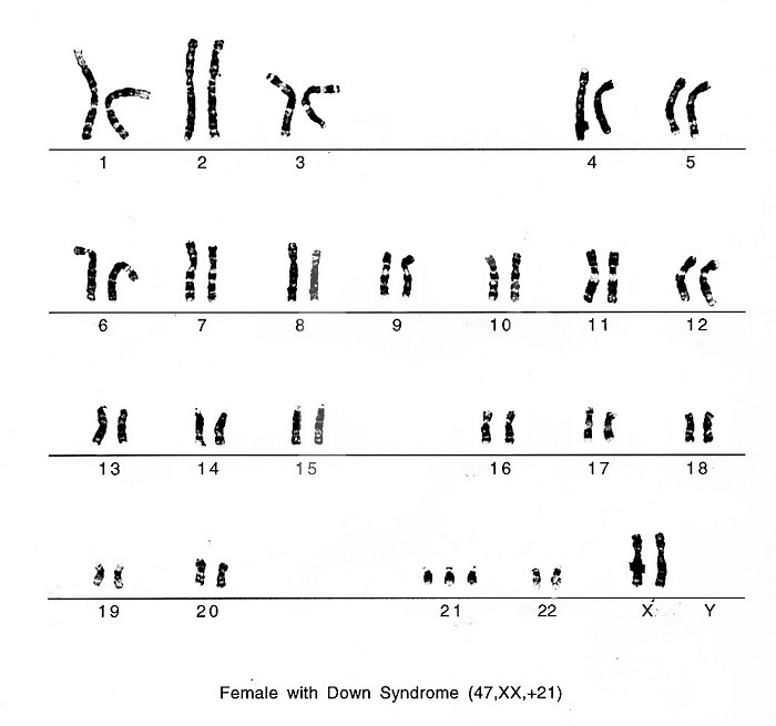 Karyotype of a female with Down Syndrome.