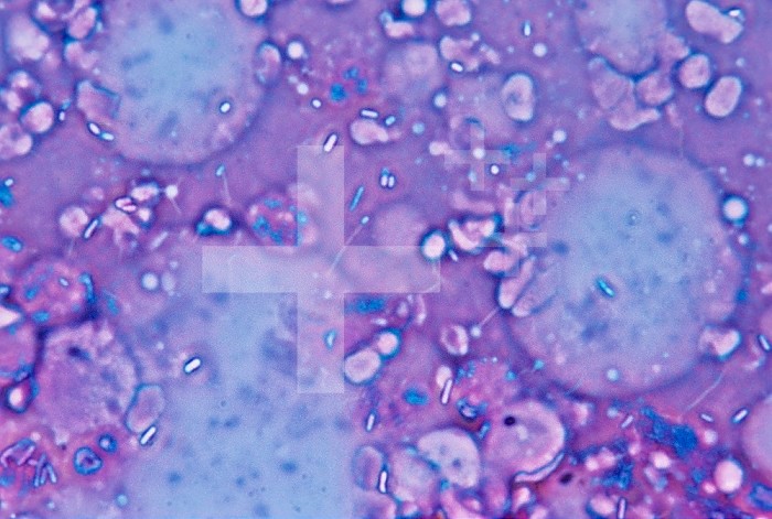 Section of human tissue from a patient with gas gangrene caused by the Clostridium welchii (also known as Clostridium perfringens) Bacteria. LM X650