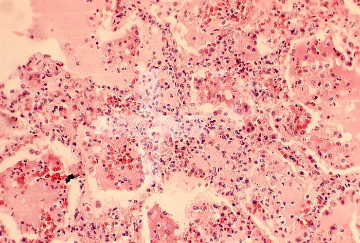 Human lung tissue from a patient with bronchial pneumonia. LM X120.