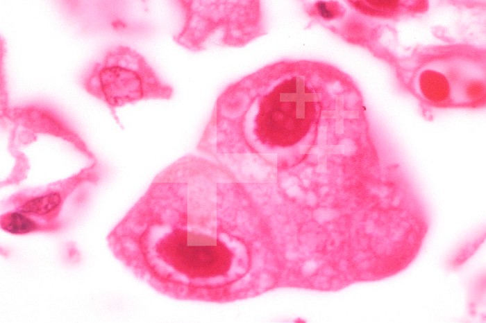 Cytomegalovirus with a large inclusion in the nucleus of lung cells. LM X250