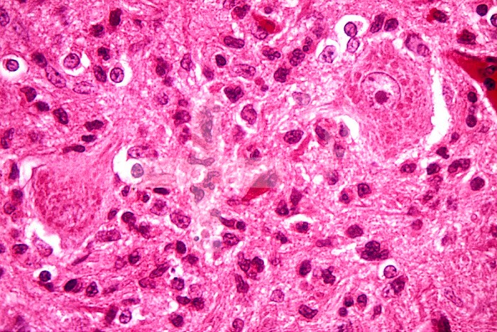 Negri bodies in the brain tissue of a rabies patient. LM X250.
