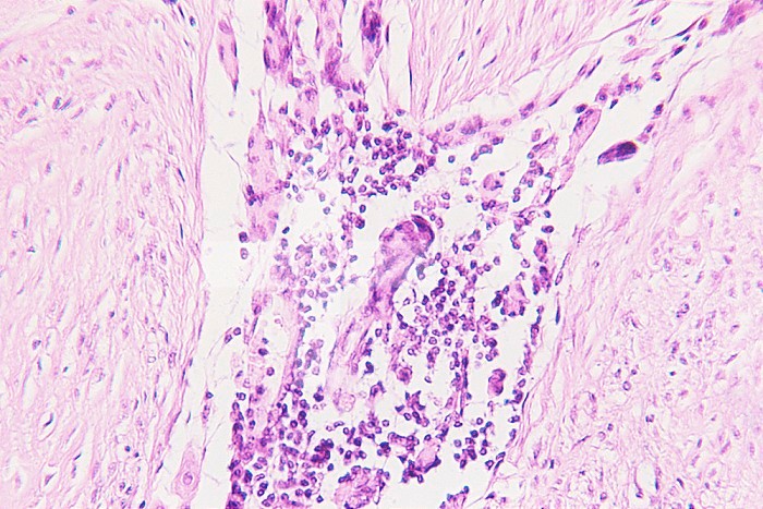 Cross-section of human muscle tissue showing a neoplastic proliferation of a desmoid tumor. LM X80.