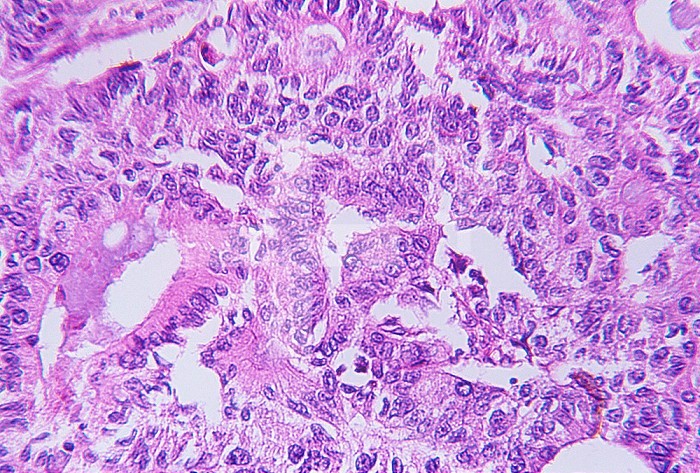 Primary carcinoma of the human colon. LM X80.