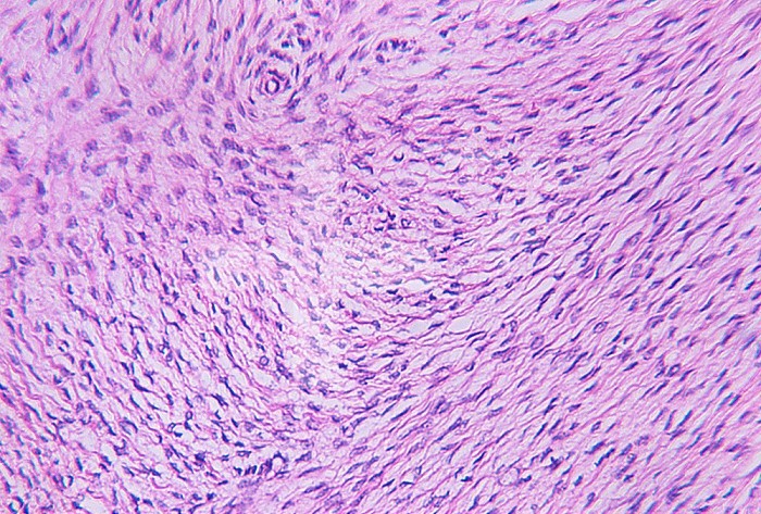 Cross-section of the human ovary showing a benign thecoma. LM X80.
