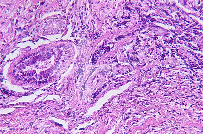 Cross-section of breast tissue showing a mastitis abcess. LM X80.
