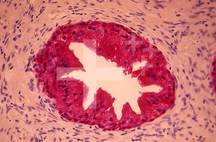 Human prostate. Prostate specific antigen was labeled with PSA antibody and stained red. LM X64.