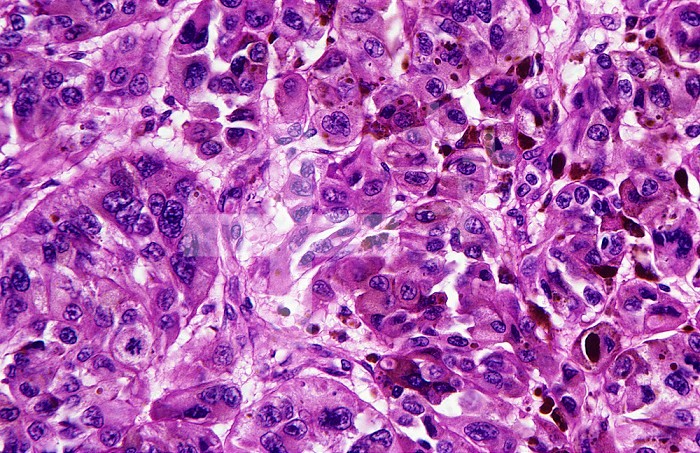 Skin section from a patient with malignant melanoma. LM X106.