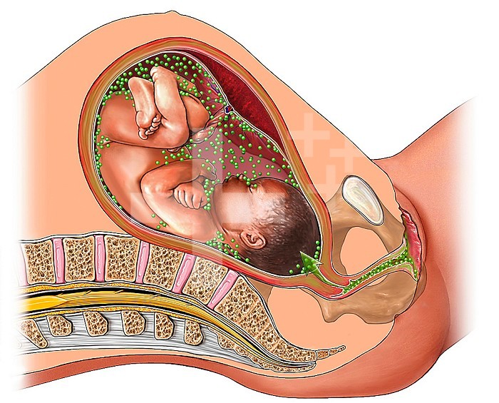 Medical illustration of a birthing complication, showing an intrauterine infection during pregnancy. It features a cut-away view of a uterus with a fetus inside and a green color to represent the infection.