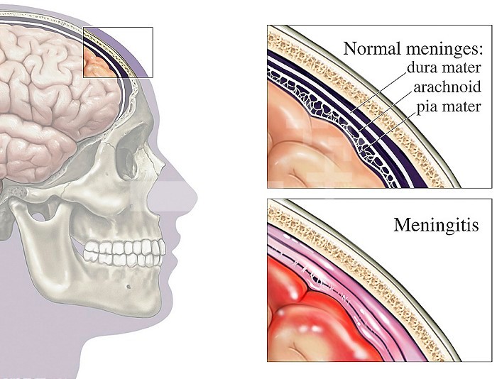 Medical illustrations of the normal human meninges compared with those associated with bacterial meningitis (brain covering infection).