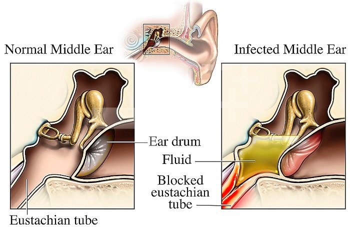 Illustrations comparing cut-away views of a normal and an infected human middle ear. Labels identify the ear drum, Eustachian tube, blocked Eustachian tube, and fluid.
