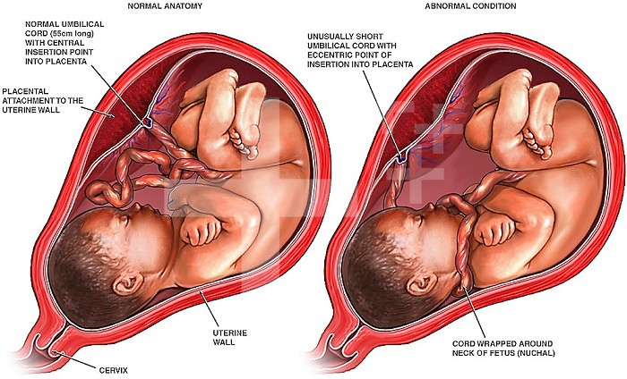 Medical illustration contrasting a normal third trimester fetus in utero with one with abnormalities of the umbilical cord. Included fetal abnormalities are an unusually short cord and a nuchal cord, where the umbilical cord wraps around the fetus's neck.
