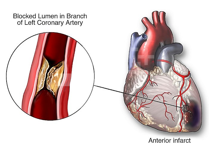 Medical illustration of a blocked coronary artery of the human heart, showing obstruction of the left anterior descending (LAD) coronary artery, the so-called artery of sudden death, with resulting myocardial infarction (MI) or heart attack.