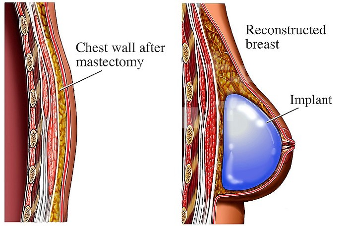 Biomedical illustrations of the primary reconstruction of the breast following a total mastectomy, from a sagittal view (cut-away section viewed from the side). It features two side-by-side comparative views of the thorax wall. The left view shows the chest wall after a mastectomy while the right image illustrates a reconstructed breast with subcutaneous implant.