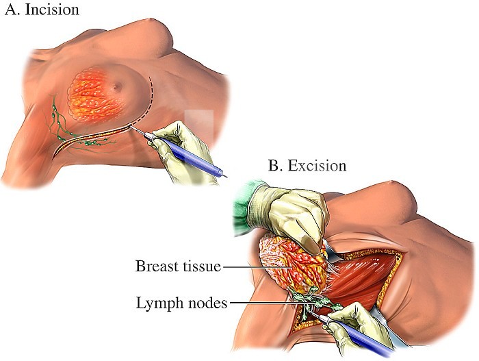 Biomedical illustration of the surgical procedure of performing a mastectomy, or removing cancerous breast tissue and lymph nodes.