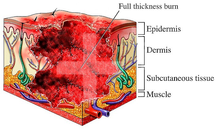 Medical illustration showing third degree full-thickness burns of the skin. The drawing demonstrates the depth and trauma of the burned tissue, indicating the damaged skin layers with labels for epidermis, dermis, subcutaneous fat, blood vessels, nerves, and muscle.