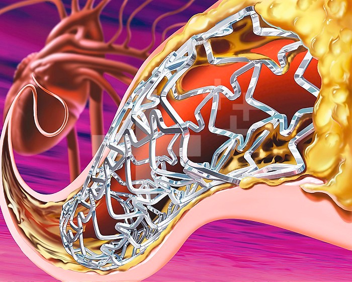 Stent in coronary artery of the heart.
