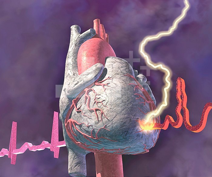 Heart attack, graphic representation of heart attack.