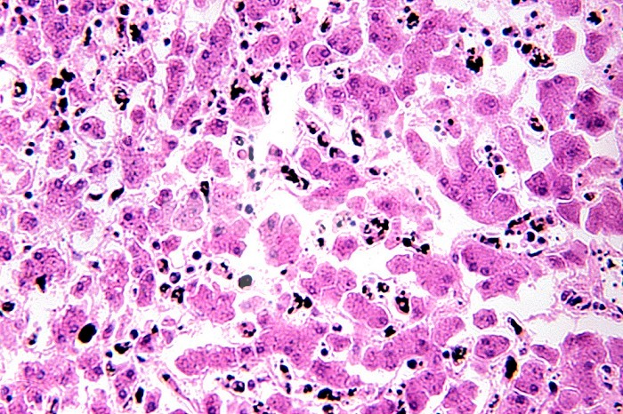 Plasmodium falciparum Protozoa in a liver section. LM X80