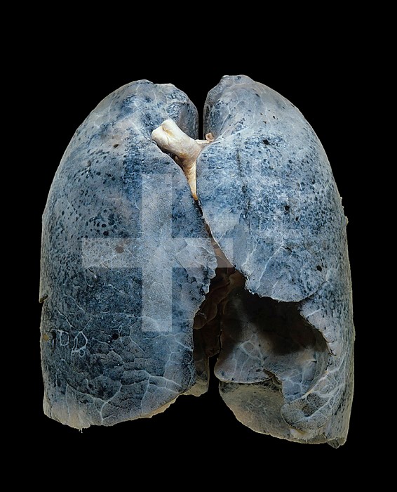 A smoker's damaged lungs.