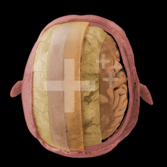 Cranial vault step dissection from above showing the cranial cavity and coverings. From left to right: skin, epicranial aponeurosis, connective tissue, bone, dura mater, arachnoid mater, cerebral hemisphere covered by pia mater (meninges).