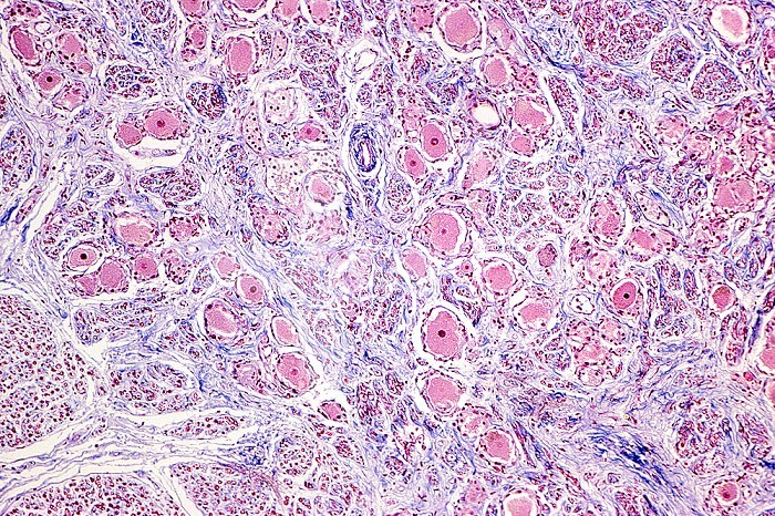 Human autonomic nervous system ganglion showing a collection of neurons with abundant pink cytoplasm and small nuclei, trichrome stain. LM X26