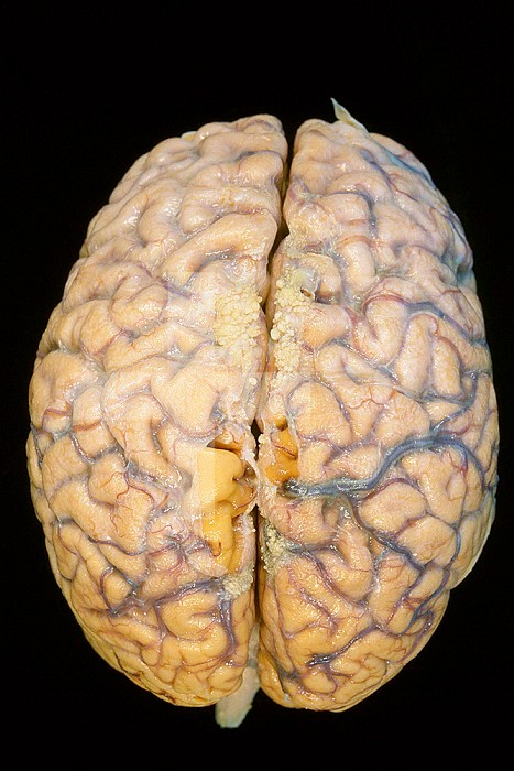 Dorsal surface of a human brain showing vasculature LM