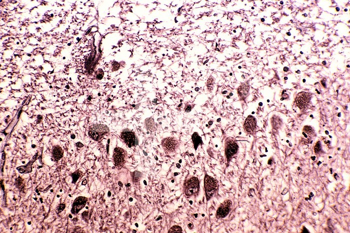 Alzheimer's disease with neurofibrillary tangles in the cerebellum of a human brain, silver stain. LM X250.