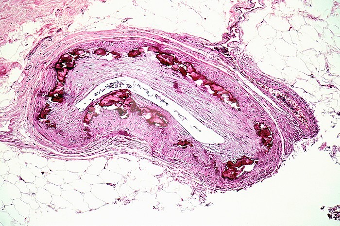 Arteriosclerosis with calcification of a human arterial wall, H&E stain. LM X26.